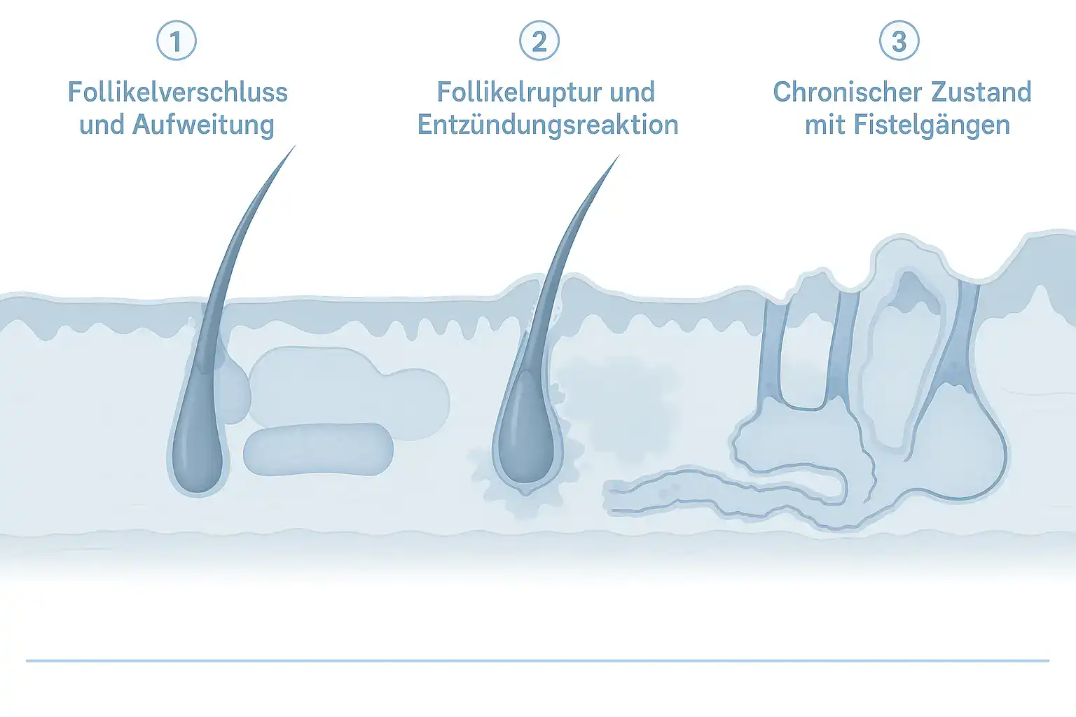 Grafik zeigt den Krankheitsmechanismus der Akne inversa von verschlossenem Follikel über Entzündung bis zu chronischen Fistelgängen.