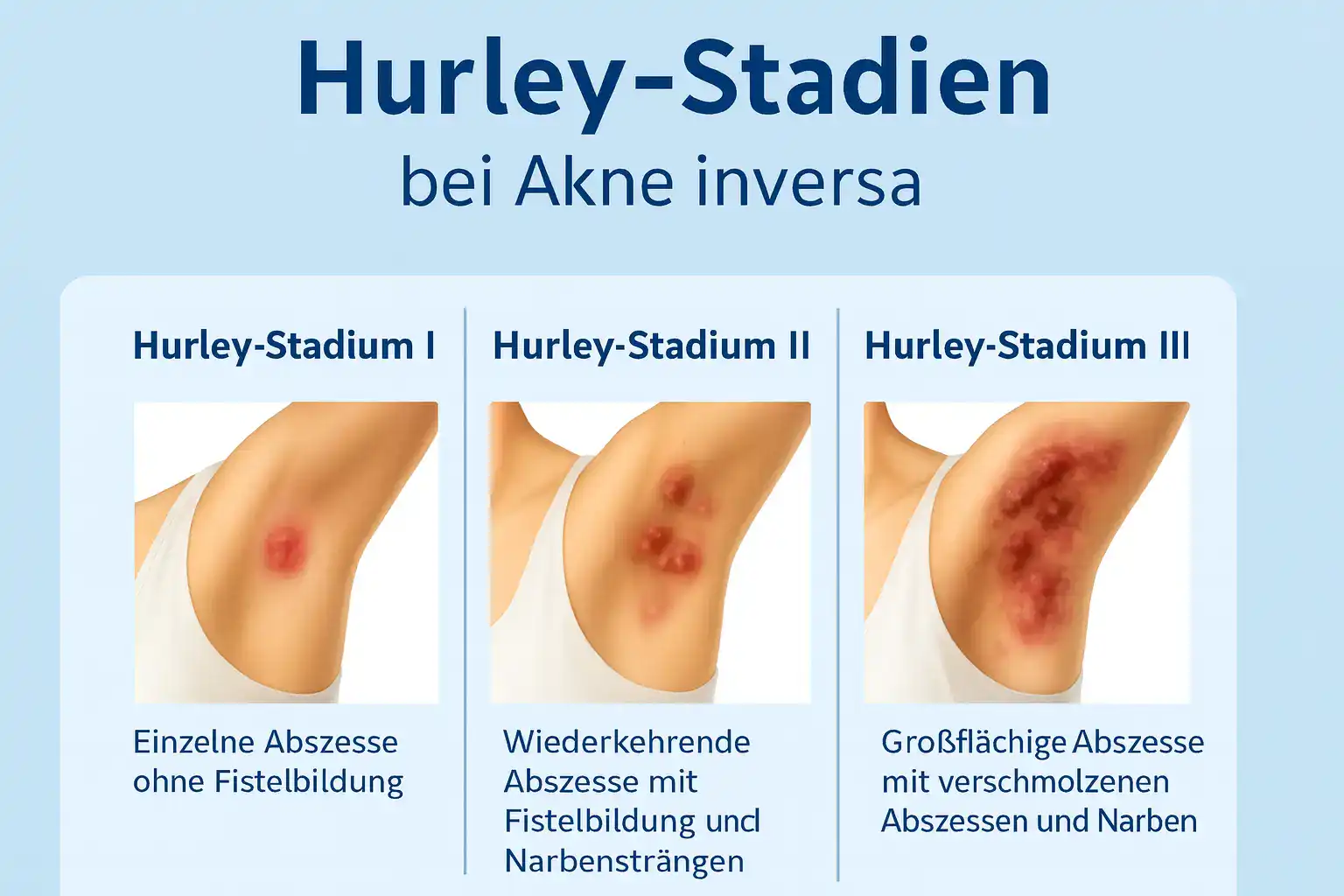 Hurley-Stadien der Akne inversa mit Abszessen in den Stadien I bis III