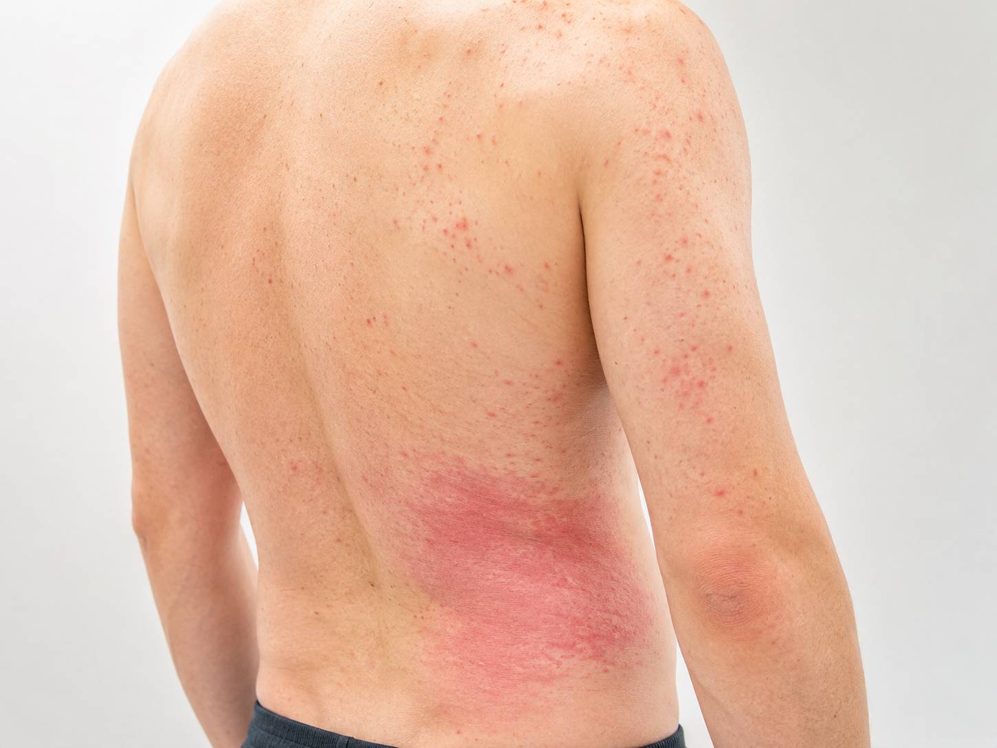 Großflächige Hautrötung mit kleinen roten Flecken am rechten Rücken und Oberarm bei Raupendermatitis.